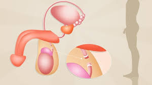 Esta técnica cirúrgica é a intenção mais qualquer homem pode ser esterilizados por vasectomia. Vasectomia Dr Marcelo Thiel