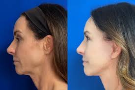 Facelift Newport Beach