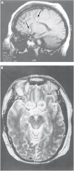 Anteriorly, it continues as subgenual area which is located just below the genu of. Limbic System Cingulate Cortex Chapter 12 The Brain And Behavior