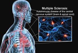 Multiple sclerosis signs and symptoms may differ greatly from person to person and over the multiple sclerosis and other inflammatory demyelinating diseases of the central nervous system. Can You Die From Ms Early Signs Symptoms And Treatment