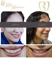 قشنگترين حس دنياست، وقتي تو زيباتر ميخندي😍 #ارتودنسي #ارتودنسی_فک  #ارتودنسی_سرامیکی #ارتودنسی_دوفک #ارتودنسی_قسطی #دکتر_رویا_هاشمی #ایران  #امارات