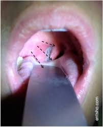 Image result for Peritonsillar Abscess