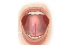 Frenillo Lingual Corto Anquiloglosia Infogen