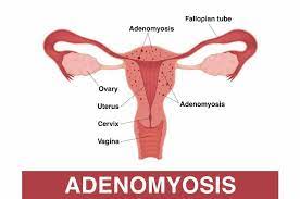 Con l'adenomiosi non si scherza. Adenomiosi Uterina Cause Sintomi E Trattamento