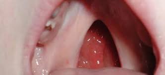 Maybe you would like to learn more about one of these? Ø§Ù„Ø²Ù‡Ø±ÙŠ Ø§Ù„Ø«Ø§Ù„Ø«ÙŠ Ø§Ù„Ø£Ø¹Ø±Ø§Ø¶ ÙˆØ§Ù„Ø¹Ù„Ø§Ø¬ Ù…Ù† Ù…Ø±Ø¶ Ø§Ù„Ø²Ù‡Ø±ÙŠ Ø§Ù„Ø«Ø§Ù„Ø«ÙŠ Ø§Ù„ÙØªØ±Ø© Ø§Ù„Ø«Ù„Ø§Ø«ÙŠØ© Ù…Ù† Ù…Ø±Ø¶ Ø§Ù„Ø²Ù‡Ø±ÙŠ Ù‡ÙŠ Ù…Ø¸Ø§Ù‡Ø± Ø¹Ø¸Ù…ÙŠØ© Ù‡Ù„ ÙŠØ¹Ø§Ù„Ø¬ Ù…Ø±Ø¶ Ø§Ù„Ø²Ù‡Ø±ÙŠ Ø§Ù„Ø«Ø§Ù„Ø«ÙŠ