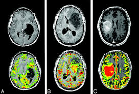 update on brain tumor imaging from anatomy to physiology