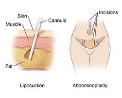 The adhesive must be applied to the scalp and only after it becomes slightly tacky can you gently position the hair system into place. Abdominoplasty With Liposuction