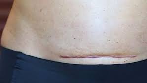 Luka melecur ini lebih serius kerana ia melibatkan epidermis dan dermis. 5 Cara Perawatan Luka Ringan Di Rumah
