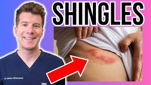 Image result for shingles