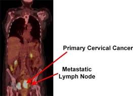 Cervical cancer presents a special challenge because you may not notice any signs or symptoms, especially when the condition is in its earliest stages. Pet Scans After Therapy Improve Cervical Cancer Survival Predictions The Source Washington University In St Louis