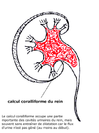 C'est la question que vous vous êtes posés après avoir enfoncez vos doigts sur votre gorge pour vous inciter à vomir afin d'éjecter l'os. Calculs Urinaires
