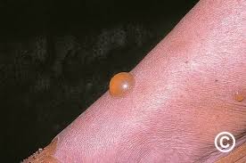 Image result for Papular urticaria