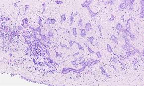 Focused cysts with stained slides of pathology. Pathology Outlines Mesothelioma Pleura Epithelioid