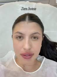 Toxina Botulinica BoToX , ANTES e DEPOIS , Botox, consolidou-se como um dos  procedimentos estéticos e terapêuticos mais importantes da medicina  moderna. Sua principal relevância reside na capacidade ...