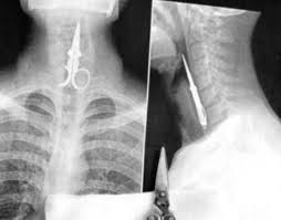 Some Of The Strangest Objects Found In X Rays X Ray X Ray Images Medical