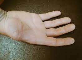 🚀 LEON 🚀 auf Twitter: „100% real picture of @ToughTimmy's new thumbless  hand. We all wish you luck on your 4 fingered future. RT for Missing Thumb  Awareness https://t.co/1GbljnrXXr“ / Twitter