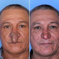 Rhinophyma is a skin disorder that causes the nose to enlarge and become  red, bumpy, and bulbous. It is thought to result from untreated, severe  rosacea, a chronic inflammatory skin condition that