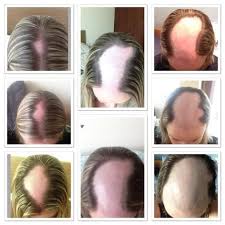 12 Things People Living With Alopecia Want You To Know Hair Loss Treatment Shampoo Hair Loss Women Alopecia