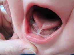 You cannot adequately evaluate a baby's mouth when they are sitting in a parent's lap in an upright position. Information On Tongue Tied Babies