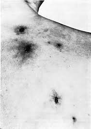 Image result for Neurotic Excoriation