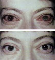 Uterine polyp removal is a procedure that you may have done to ease symptoms or improve fertility. Functional Endoscopic Sinus Surgery American Family Physician