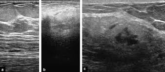The appearance of normal breast tissue on a mammogram. Inflammatory Breast Disease The Radiologist S Role Sciencedirect