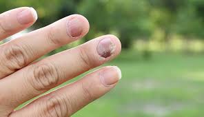 A doctor explains the differences between a melanoma black line under the fingernail and a normal this is a very concerning sign and usually is best addressed by a biopsy of the nail bed or, at the a malignant tumor in a nail nearly always affects just one nail. What Are Your Nails Saying About Your Health
