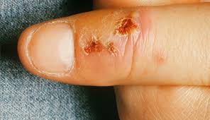 Image result for Herpes Simplex