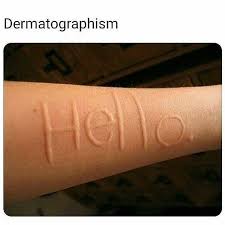 Image result for Dermatographism