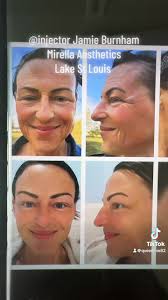 Just another day in the office 😊 , #beforeandafter #lakestlouisspa  #lakestlouis #mirellaaesthetics_lsl #glostudiowithjamie