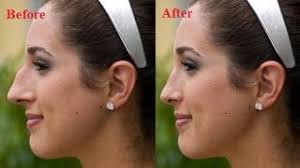 The average cost of rhinoplasty is $5,409, according to 2019 statistics from the american society of plastic surgeons. 10 Try It Ideas Nose Job Plastic Surgery Celebrity Plastic Surgery