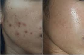 L'acné de l'adulte, aussi appelée acné tardive, touche un peu plus d'un quart de la population adulte et majoritairement les femmes. Acne Adulte Comment Je M En Suis Debarrasse Photos Avant Apres The Ordinary Mario Badescu Skinceuticals Uriage Benton Drunk Elephant Cosrx Tony Moly Rosette