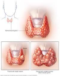 Pin On Hashimotos Disease
