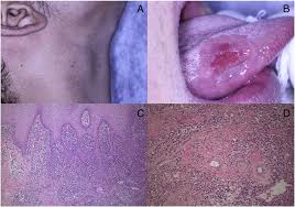 Learn more about syphilis from the experts at webmd. Oral Syphilis Report Of Three Cases And Characterization Of The Inflammatory Cells Sciencedirect