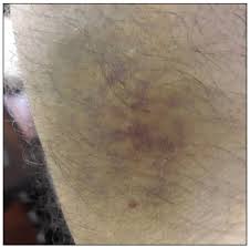 Cherry angiomas have bright appearance and due to this property, your dermatologist or doctor should be able to tell you if you have cherry angioma without needing to do extra testing. A Case Of Covid 19 With Papulovesicular Rash That Progressed To Retiform Purpura Accompanied By Cherry Angiomas