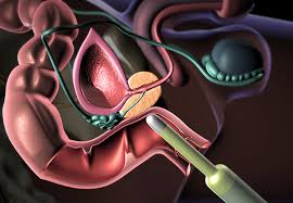 Jonathan epstein, md, director of surgical pathology at johns hopkins hospital in baltimore and a leading provider of second opinions on prostate exams, said in a terse email: Debating The Frequency Of Biopsy In Monitoring Low Risk Prostate Cancer Consult Qd