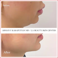 Double Chin Treatment Slimmer Jawline La Beauty Skin Center