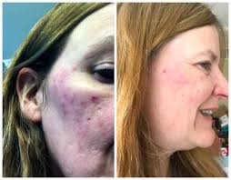 Emme Diane Acne Treatment Success