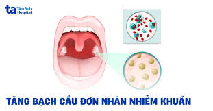 Bệnh tăng bạch cầu đơn nhân nhiễm khuẩn: Nguyên nhân và triệu chứng