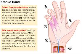Handchirugie Bei Einem Karpaltunnelsyndrom Gesundheitsberater Berlin