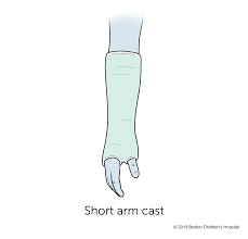 Image result for Short Arm Cast