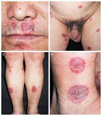 Image result for Secondary Syphilis