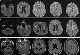 Misra uk, hashmi aa, kalita j. Herpes Simplex Encephalitis In An Immunocompromised Adult With Novel Mri And Pathology Findings Springerlink