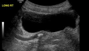 Ct Scan Is No More Accurate Than Ultrasound To Detect Kidney Stones Uc San Francisco