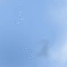 This posterior vitreous detachment is the most common cause of floaters. Eye Floaters Flashes And Spots