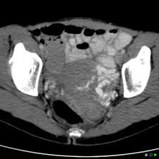 Pelvic Congestion Syndrome Radiology Reference Article Radiopaedia Org