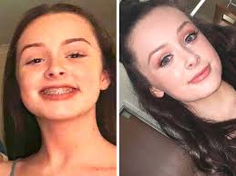 Jovem de 15 anos sofre derrame uma semana após visita ao dentista