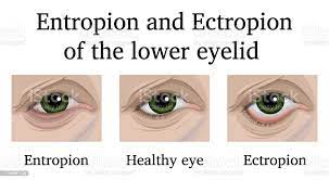 Ectropion - When it couldn’t get worse, it can only get better