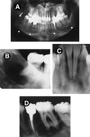 Check spelling or type a new query. Management Of Florid Cemento Osseous Dysplasia Of The Mandible Producing Solitary Bone Cyst Report Of A Case Journal Of Oral And Maxillofacial Surgery