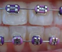 Black And Light Purple Braces Braces Vs Invisalign Costs Ehow Cute Braces Colors Cute Braces Braces Colors Combinations